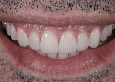 6 Facettes céramiques feldspathiques hautement esthétiques