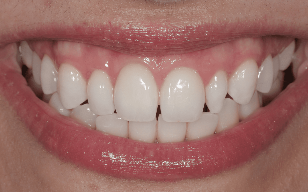 Cas 2- Blanchiment Interne