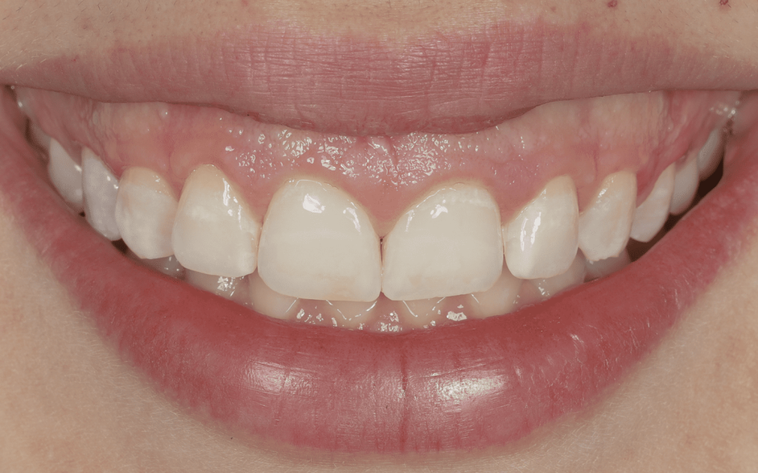 Taches sur les dents