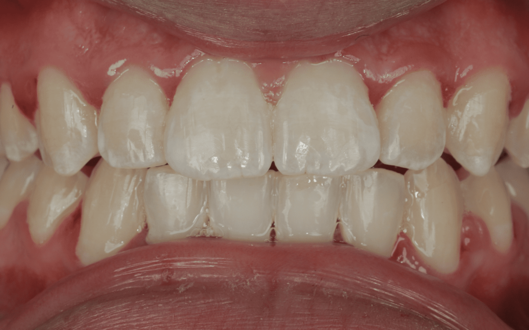 Orthodontie chez l’adolescent