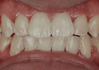 Orthodontie chez l’adolescent