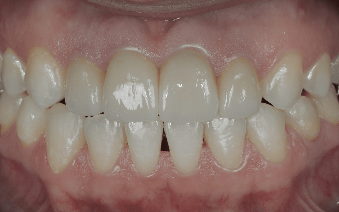 Orthodontie, Blanchiment et Couronnes Céramiques