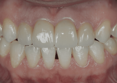 Orthodontie, Blanchiment et Couronnes Céramiques