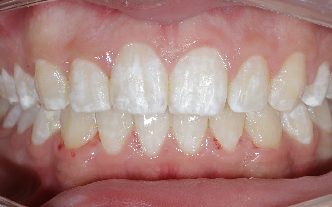 Traitement de la supraclusion avec brackets