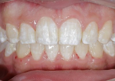 Traitement de la supraclusion avec brackets